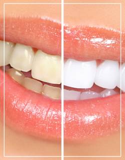 Teeth Whitening Near Me in Woodbridge, NJ